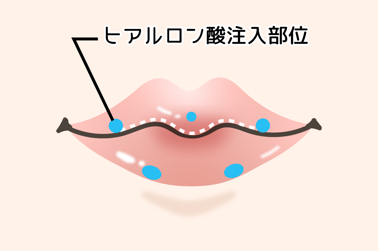 M字リップで立体感のあるくちびるに